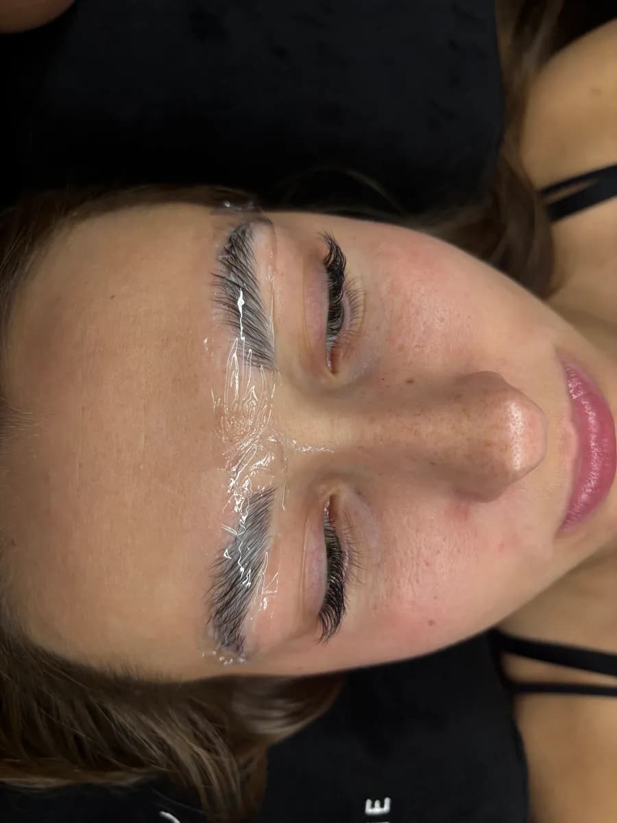 Browlift en cours de pose